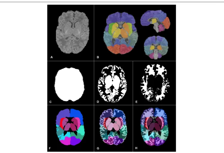 FIGURE 2 | Images and segmentation obtained through our pipeline adapted for preterm infants
