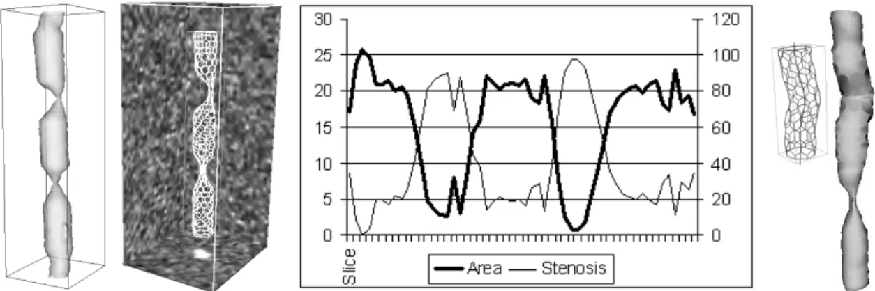 Fig. 7. Simulation of stent/vessel-wall interaction in a physical phantom of stenosed ves- ves-sel