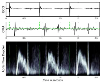 Figure 1. ECG, CMA and aortic flow Doppler. The be- be-ginning of each beat, the opening and closing of the aortic valve appear as dotted lines on the lower panel.