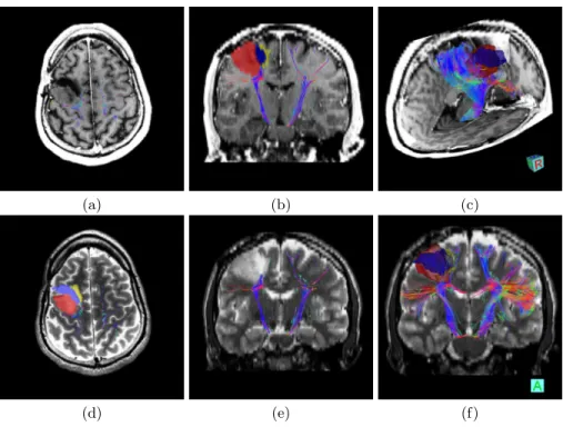 Fig. 1. Illustration of CST on the First Patient. Combined views of the obtained fiber tracts overlayed on T1 (a,b,c) and T2 (d,e,f), illustrating the proximity of the tumor to crucial motor pathways