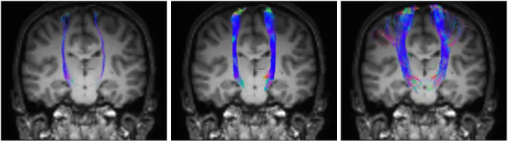 Fig. 1. Tractography of the HMFs in the left and right hemispheres. From left to right: DTI, ODF and DDI