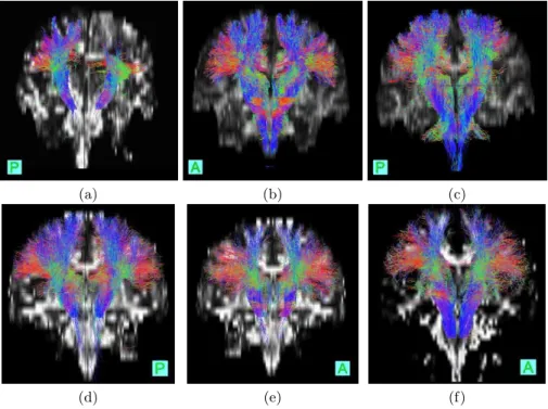 Figure 2 shows the reconstructed CSTs on both patients overlaid on the FA map. For patient 1 (fig