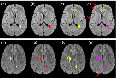 Fig. 2: (a) Original FLAIR image followed by FLAIR image and superimposed MS lesion segmentations from: (b) experts segmentation, (c) proposed  frame-work, (d) FDR-correction