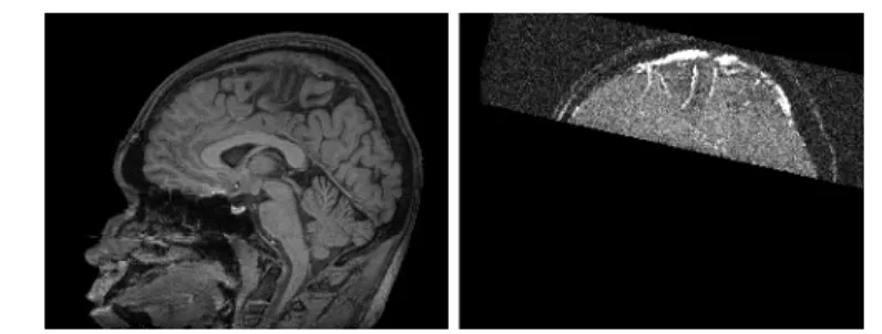 Fig. 1. Sagittal slices of the processed data. Left: T1 MRI of the whole head. Right: