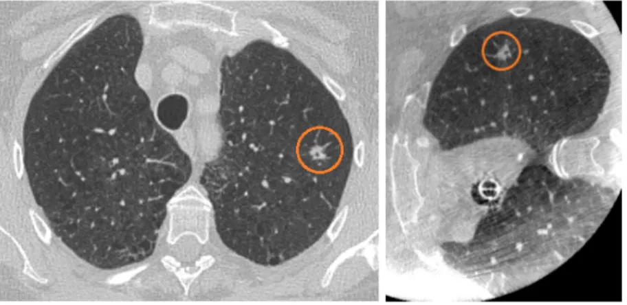 Figure 1 shows an axial view of the images. Although the nodule is here clearly visible in both modalities, it is worth mentioning that it might not be the case, particularly for GGO nodules