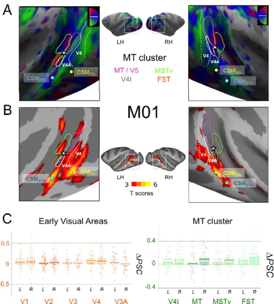 Figure 5: A) Retinotopic mapping of the Superior Temporal Sulcus (STS) for M01 and  delimitation of the MT cluster areas: MT (dark blue), V4t (pink), MSTv (orange), and FST  (green)