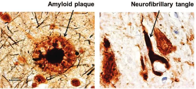 Figure  1:  Amylpoid  plaques  and  neurofibrillary  tangles  in  a  section  from  the  hippocampus of an AD patient (Images taken from coloradodementia.org)