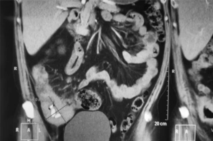 Fig. 1. Colonoscopy image showing an ulcer that extends throughout the right colon.