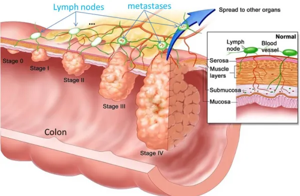 Figure 1.3: Stages of colorectal cancer. A part of the lymphatic system with the lymph nodes is depicted in green color