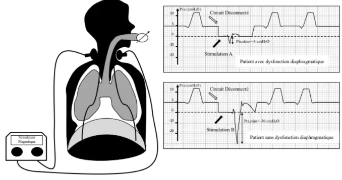 Figure  5.  Evaluation  de  la  fonction  diaphragmatique  par  la  technique  de  stimulation  magnétique des nerfs phréniques (d’après Dres et coll