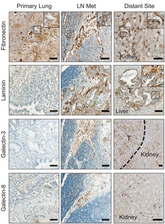 Figure 4. Metastasis-associated ECM molecules are present in the sites of metastases but not primary tumors