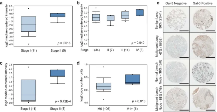 Figure 8. Metastasis-associated molecules are present in the metastases of human lung cancers (a-d) Oncomine 32  results for human lung cancer expression of LGALS3 and LGALS8