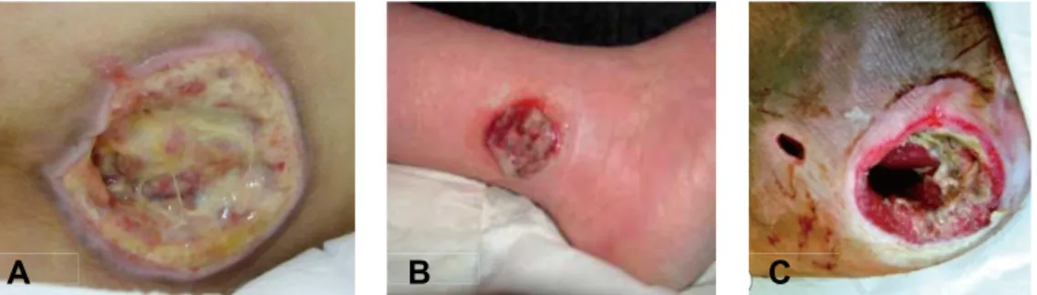Figure  10. Types of chronic wounds:  A) pressure ulcer (Inui et al. 2010),  B)  venous leg ulcer (Grey et al