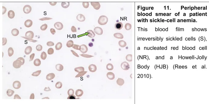 Figure  11.  Peripheral  blood smear of a patient  with sickle-cell anemia. 