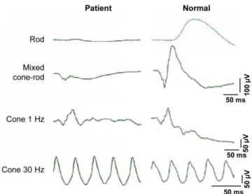 Figure 24: Representative ERG traces from a patient suffering from the Riggs-type of CSNB (left) compared to a non- non-affected individual (right) (adapted from (87)) 