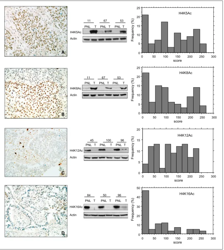 Fig. 1. Global modification of histone H4 acetylation in lung tumors. Left, immunostaining of lung cancer tissue on frozen sections using antiacetylated H4K5, H4K8, H4K12, and H4K16 antibodies (immunoperoxidase, 200)