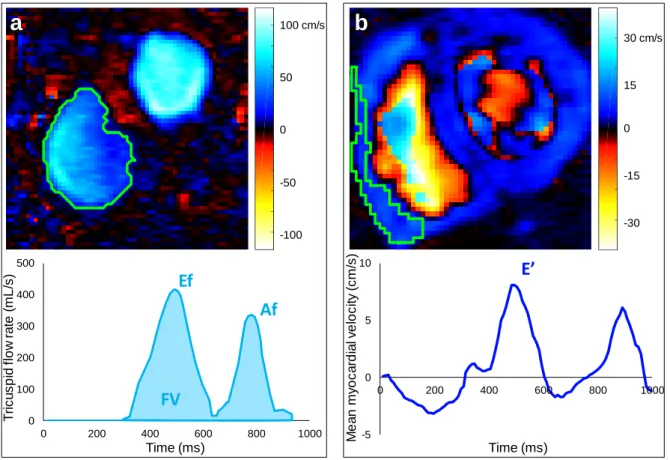 Fig.  1:  Right  ventricular  tricuspid  filling  inflow  (a)  and  myocardial  annulus  (b)  phase-contrast  (PC)-MRI  data  analysis