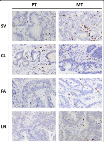 Fig. 6 Tumor microenvironment immune context. Representative immunohistochemistry of CD8 + cells in ﬁ ltrating primary (PT, left panels) and matched lung metastatic tumors (MT, right panels) (magni ﬁ cation: ×40 HPF — high-power ﬁ eld) for each patient (SV