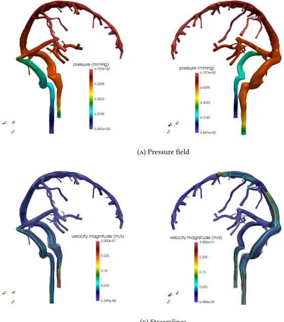 Figure 8. Cerebral venous hemodynamics obtained by imposing a pressure drop between the inlet and outlet sections