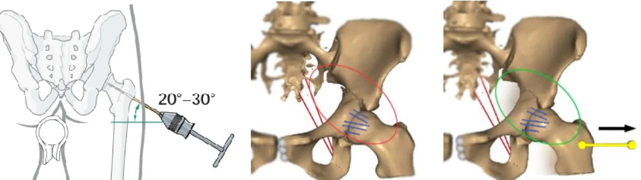 Figure  3.  Schanz  screw  (image  from  the  AO  Fondation)  and  the  simulation  of  femoral  traction  on  a  transverse  fracture