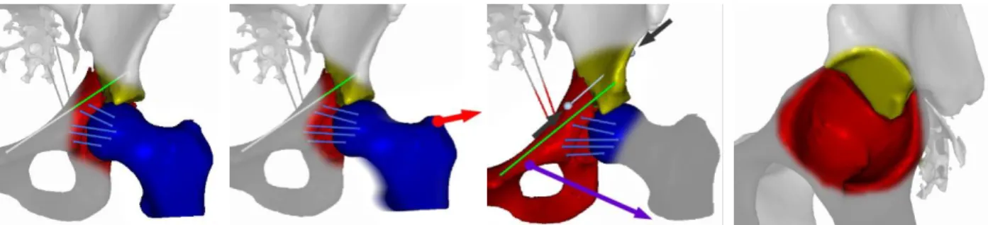Figure 5. Clinical case #2, second intervention from an anterior ilioinguinal approach