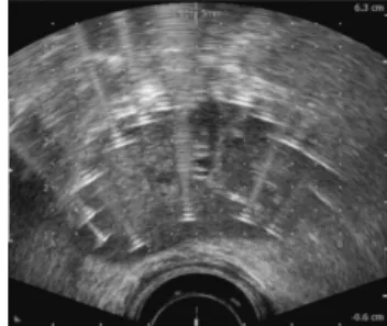 Fig. 1: 2D axial image, the needles  perpendicu-lar to the slice are  fig-ured as the points  radiat-ing linear artifacts