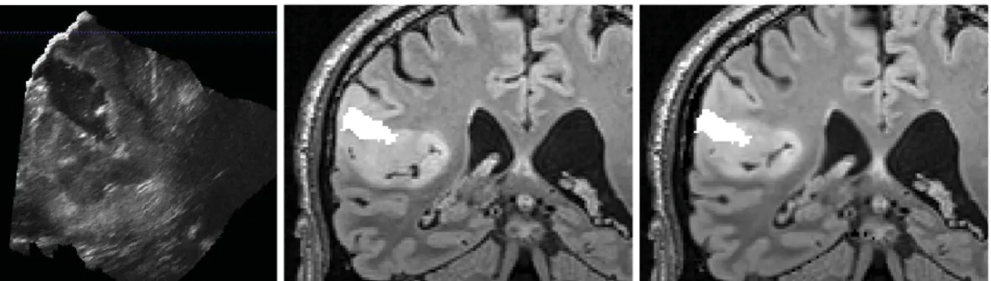 Figure 2. Intraoperative iUS image during tumor resection of case 3 (left). The resected cavity is segmented, then overlaid on the preoperative pMR (middle) and the updated pMR images (right)