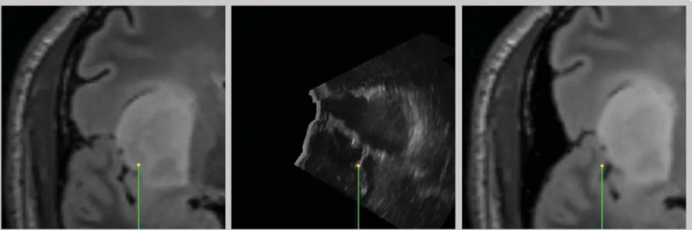 Figure 3. Brains-shift compensation for case 4, resection of a deep tumor. An anatomical landmark of the Sylvian sulcus is pointed on the pMR, iUS and updated pMR images