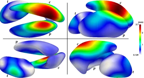 Figure 8: Shape dissimilarities of the sub-cortical structures between the two groups