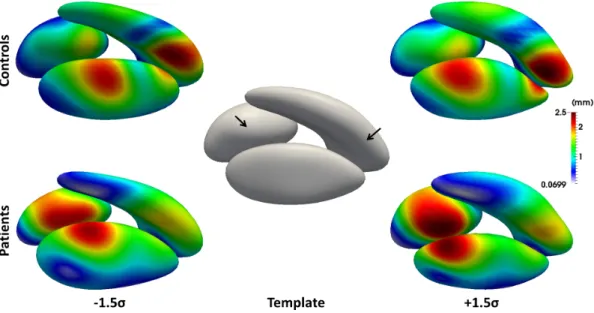 Figure 13: Second mode of variation at ± 1.5 standard deviation (σ) of two PCAs based on the two estimated covariance matrices of initial momenta Γ c α and Γ αp 