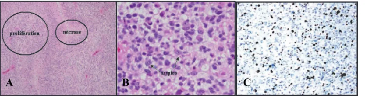 Figure  6 :  Coupe  histologique  d’un  GB  et  marquage  hématoxyline  et  éosine  (A  et  B)  Coupe  immunohistochimique d’un GB et marquage Ki67 (C)
