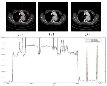 Fig 2: (1) Original CT image with marks and the result of: (2)  3D median filter, (3) 3D stick filter and (4) the grey levels of  voxels on the marks