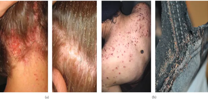 Figure 1: Nuisance related to lice: (a) scalp infection caused by head lice; (b) scraping lesions related to body lice infestation.