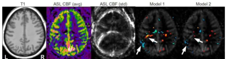 Fig. 1. False positive detections in a control subject perfusion map presenting ghosting artefacts