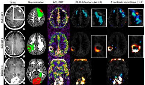 Fig. 2. Detection of perfusion abnormalities based on GLM and a contrario methods on 3 representative patients with brain tumors