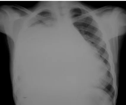 Figure 8 : RX THORACIQUE MONTRANT UN POUMON OPAQUE DROIT 
