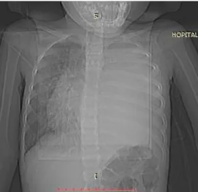 Figure 10 : RX THORACIQUE MONTRANT UN POUMON BLAC A GAUCHE  AVEC REFOULEMENT DE LA SILHOUETTE CARDIAQUE DU COTE 