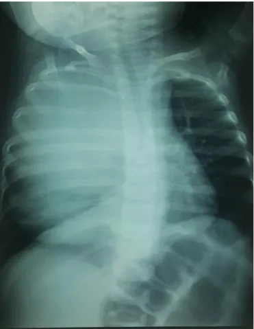 Figure 14 : opacité de l’hémithorax droit
