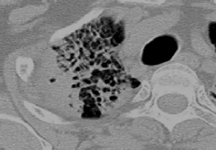 Figure 8: destruction parenchymateuse avec bronchiectasies de traction [31] 