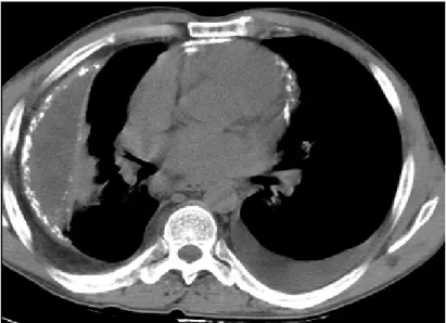 Figure 10: calcifications péricardiques, associées un épanchement pleural enkysté   et calcifié [31] 