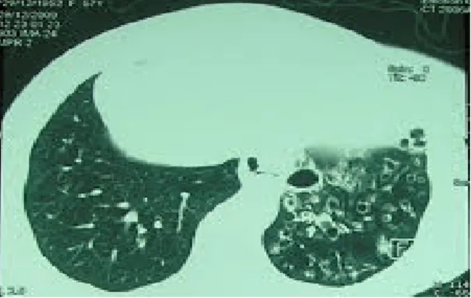 Figure 12 : image scannographique d’une DDB kystique 