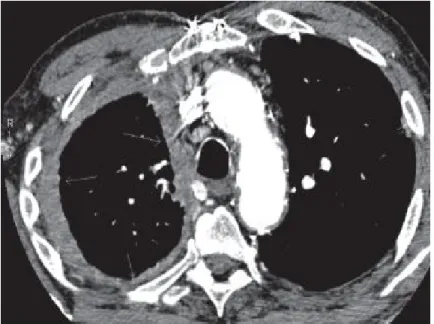 Figure 6 : Mésothéliome pleural droit [174] 