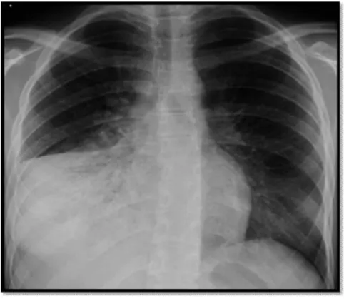 Figure 8 : Pneumonie franche lobaire aiguë [40]. 