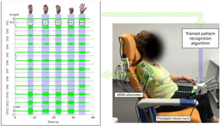 Figure 1.   Global  view  of  the  setup  along  with  the  myoelectric  activity  associated  to  the  voluntary  control  of  phantom  hand  (measured  with  12  sEMG electrodes placed over the residual limb of one participant)