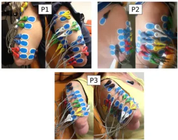 Figure 2.   12 electrode pairs were placed on the residual limb of each of the  three participants