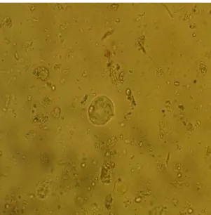 Figure 4: Entamoeaba Coli  identifiée par la technique de Ritchie à l’objectif 40                                                                 [Photo du service de parasitologie, HMIM V]