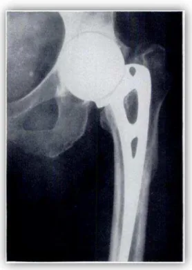Figure 4: Radiographie d’une prothèse de hanche céphalique [13] 