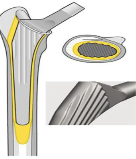 Figure 9 : La structure de la tige d’une prothèse totale de hanche cimentée[21] 