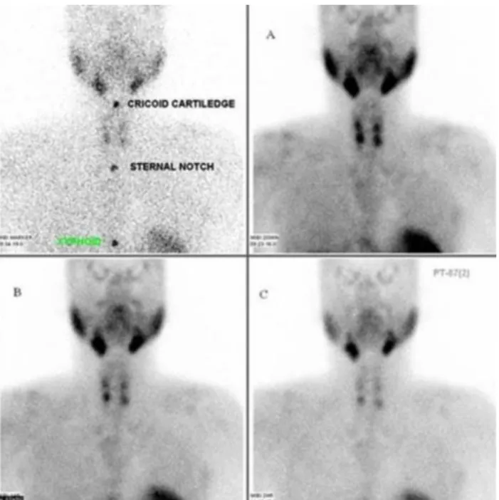 Figure 5 : Images scintigraphiques à la sestaMIBI de 4 parathyroïdes hyperplasiques  chez un patient ayant une hyperparathyroïdie secondaire