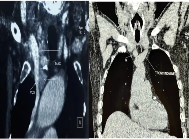 Figure 7 : TDM d’une ectopie parathyroïdienne médiastinale sur des coupes C- et C+. 